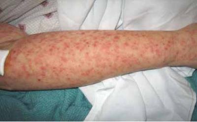 symptômes chikungunya