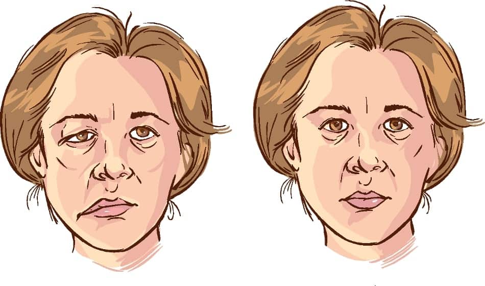paralysie faciale