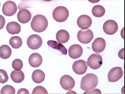 Plasmodium Falciparum