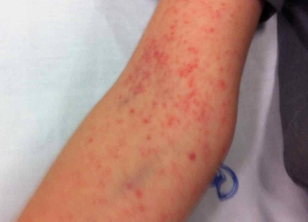 symptome dengue