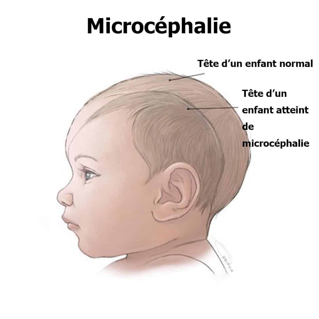 virus zika microcéphalie