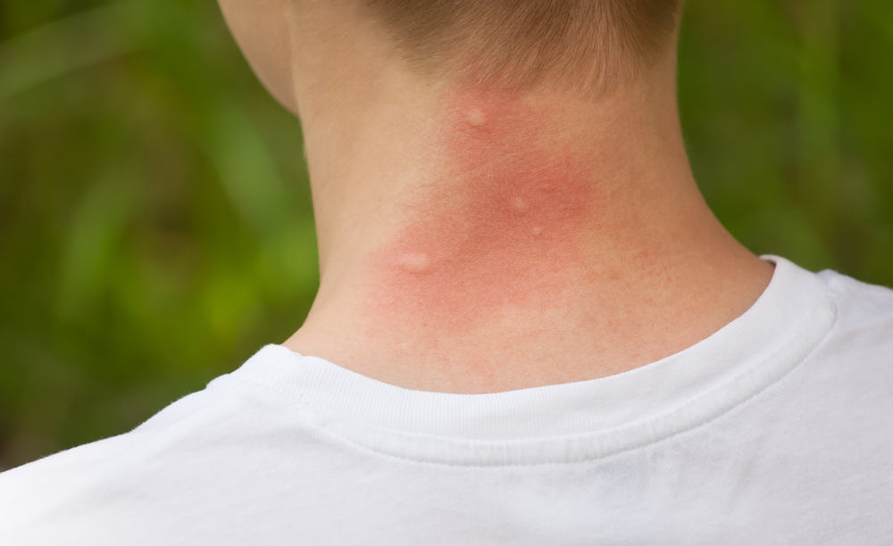 Piqûre de moustique : comment soulager, gonflement & allergie